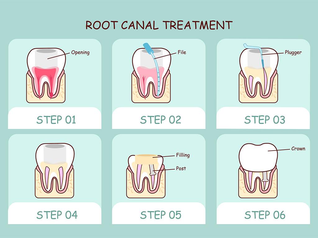 Do I Need a Root Canal?