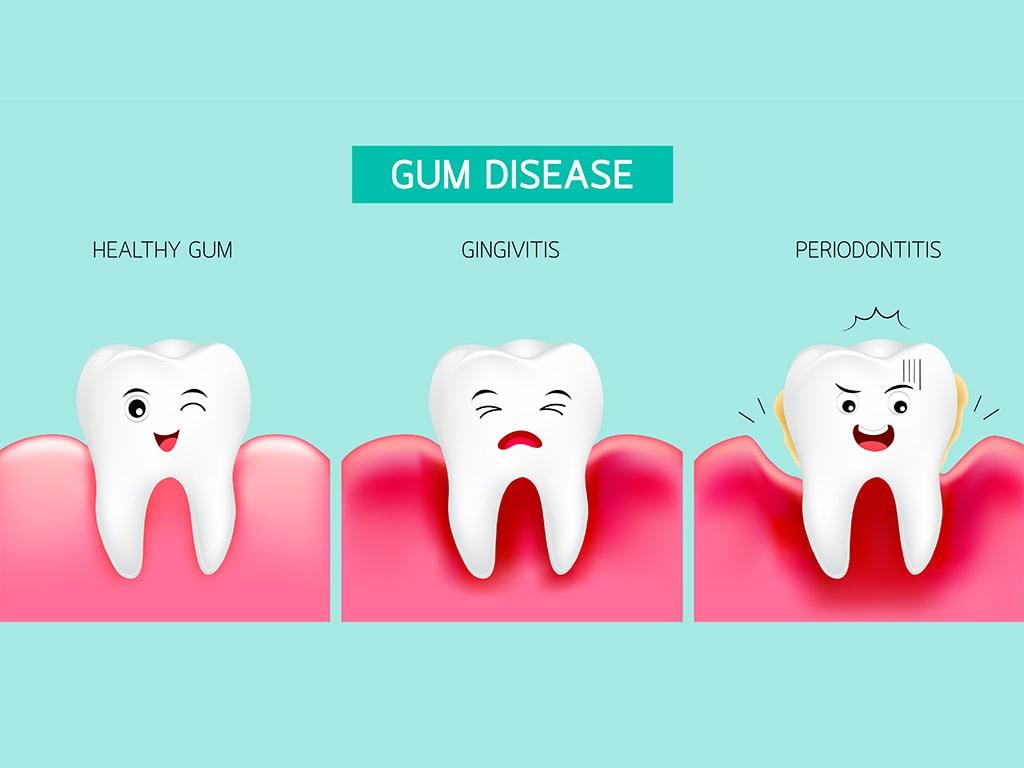 All You Need to Know About Gum Disease
