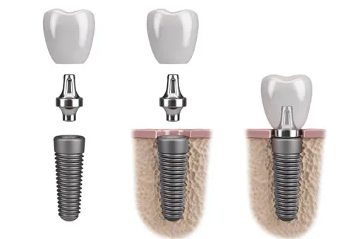Dental implant procedure stages