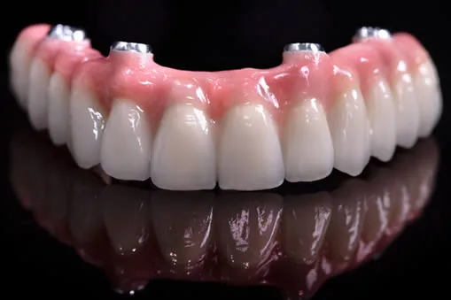 Implant supported dentures