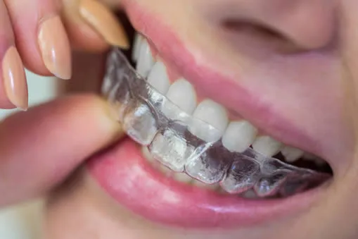Reveal clear aligner on teeth at Roam Dental Shelby Township