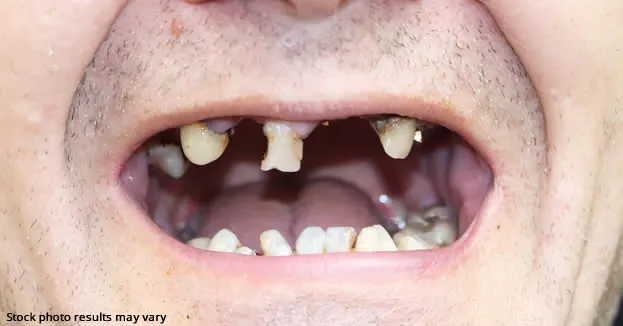 Before full mouth restoration case at Roam Dental Shelby Township