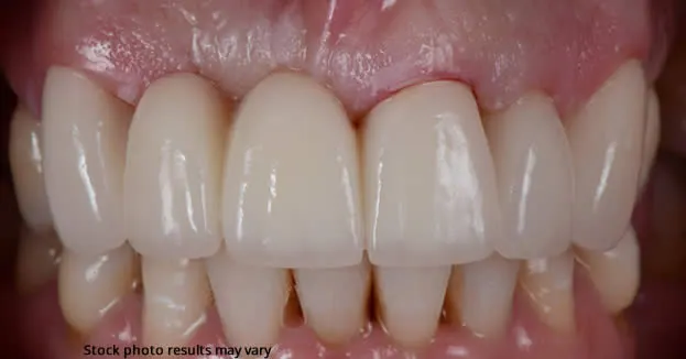 Before and after dental bridge at Roam Dental