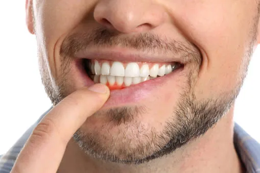 Close-up of gum inflammation showing early gum disease