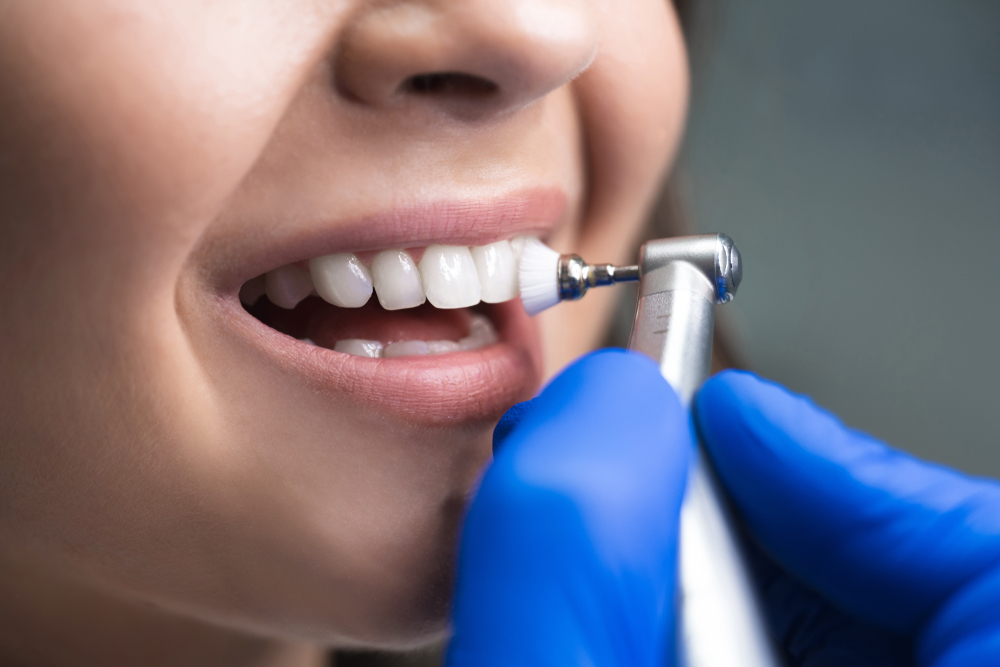 Professional dental cleaning at Roam Dental Shelby Township