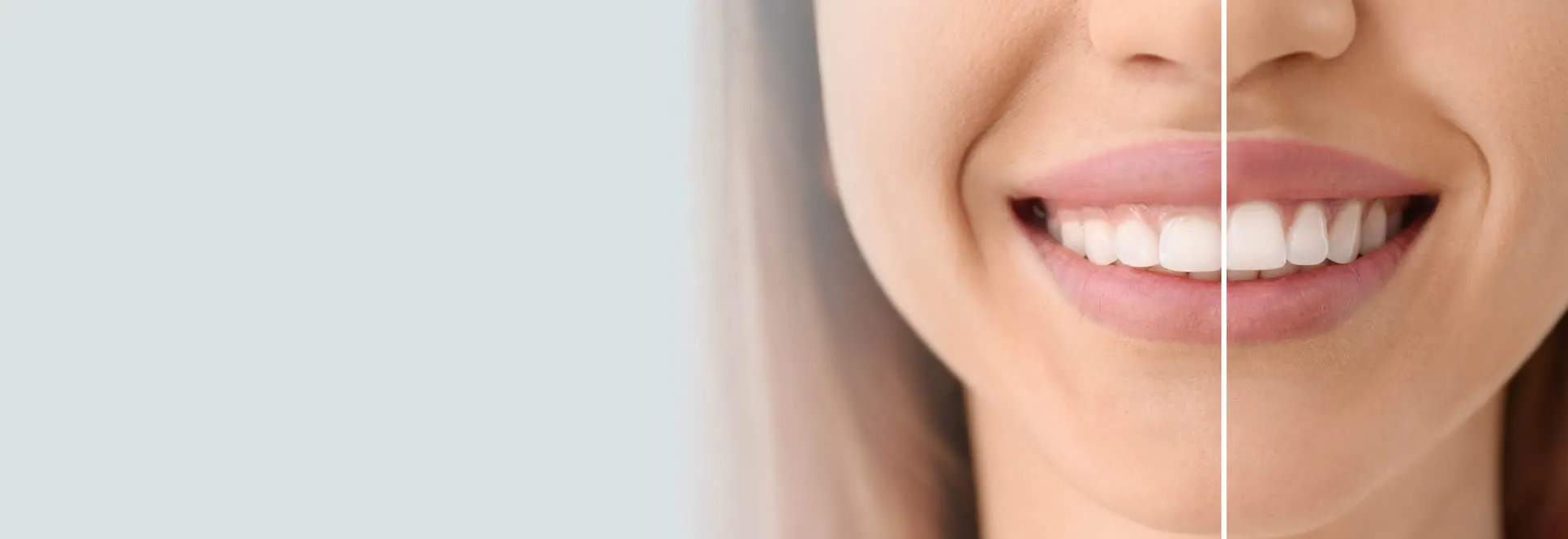 Gum lift results at Roam Dental Shelby Township