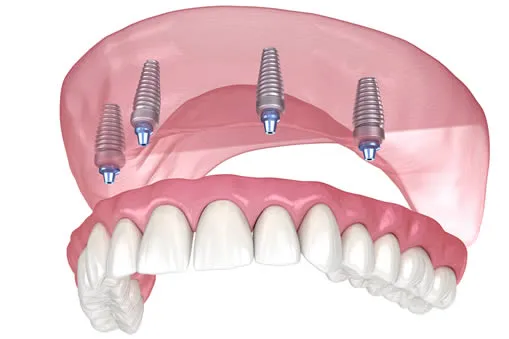 Implant-supported denture option at Roam Dental