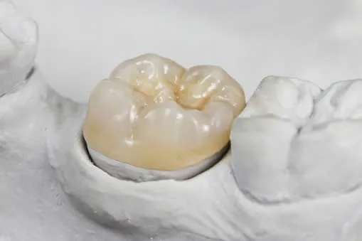 Close-up of dental onlay restoration at Roam Dental