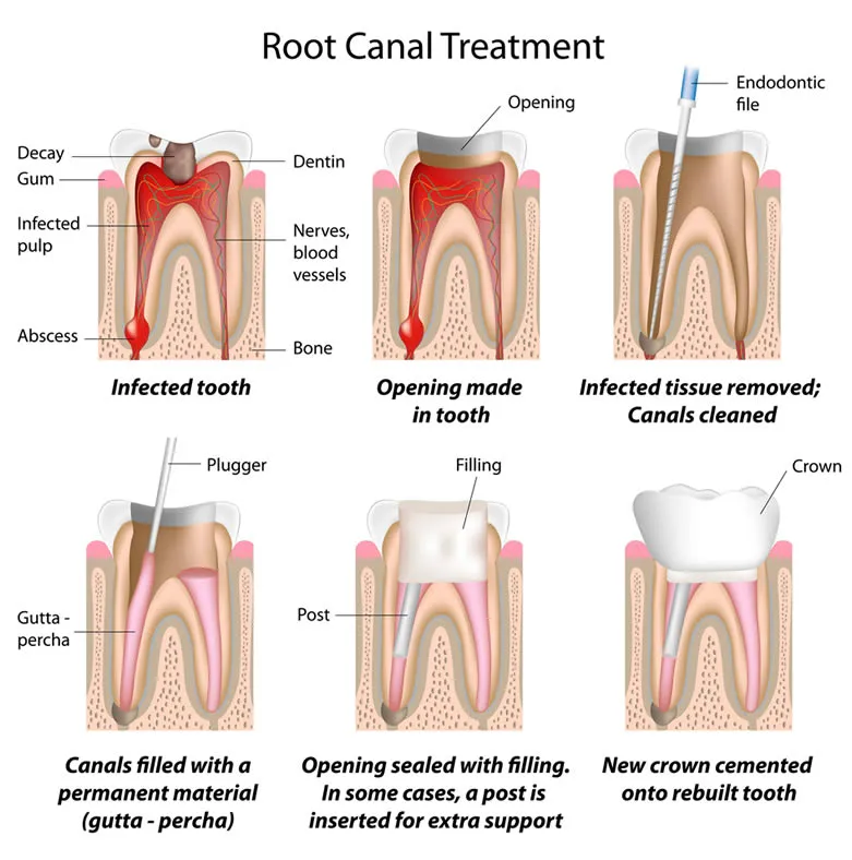 Root canal treatment stages diagram