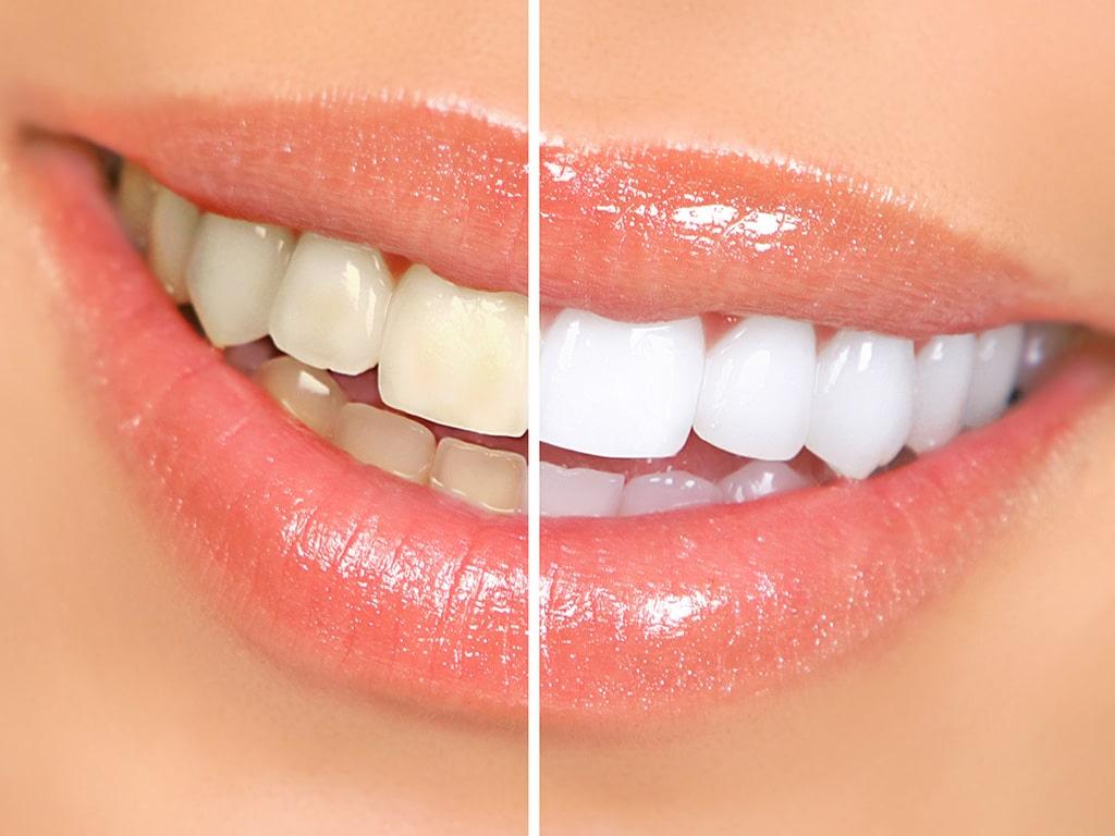 Patient receiving professional chairside teeth whitening treatment