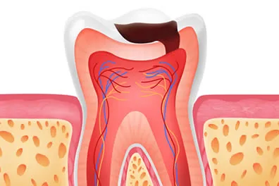 Tooth cavity illustration showing need for white filling