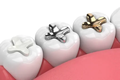 Types of dental inlays and onlays at Roam Dental Shelby Township