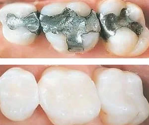 White composite filling result at Roam Dental Shelby Township