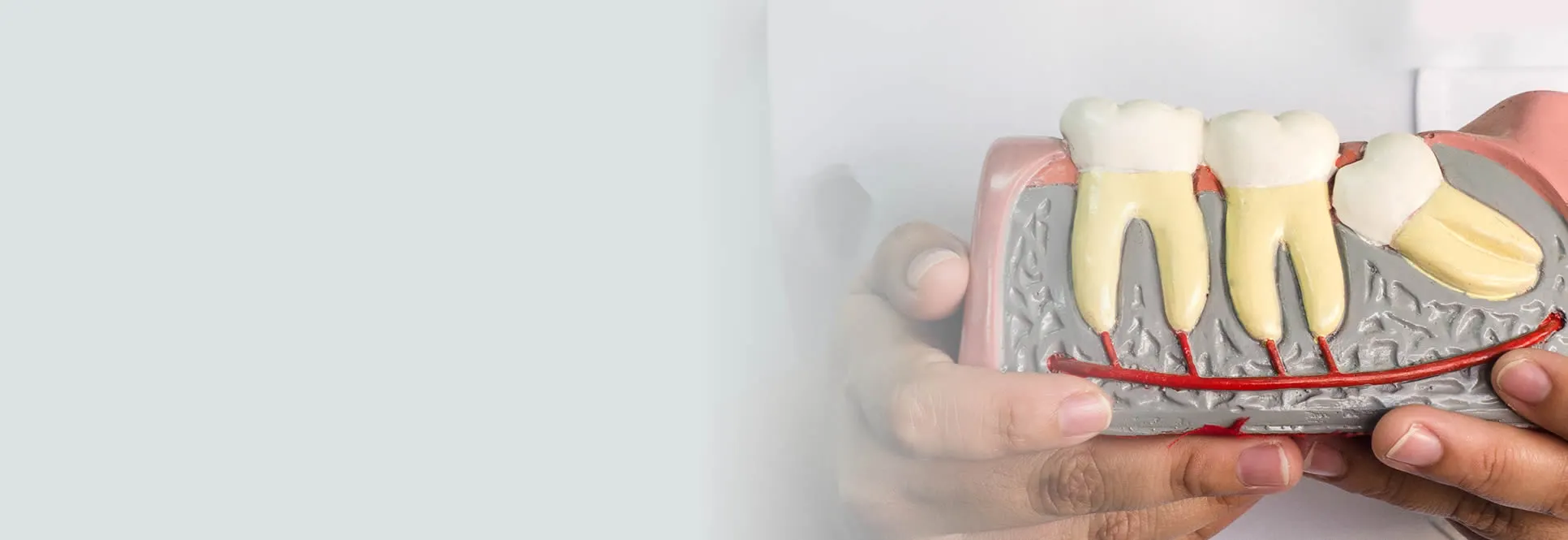 Wisdom teeth model showing impacted tooth position