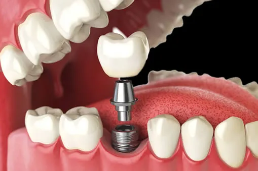 Single dental implant